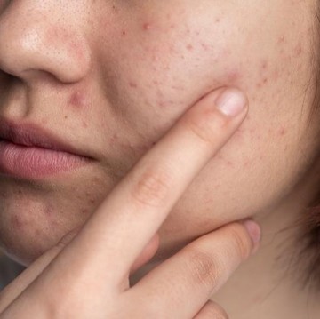 img-title Bikin Kulit Kembali Mulus, Simak Rekomendasi Skincare Andalan untuk Mengatasi Bruntusan