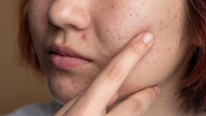 Bikin Kulit Kembali Mulus, Simak  Rekomendasi Skincare Andalan untuk Mengatasi Bruntusan