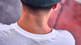 Hati-Hati, Leher Hitam Bisa Jadi Tanda Obesitas