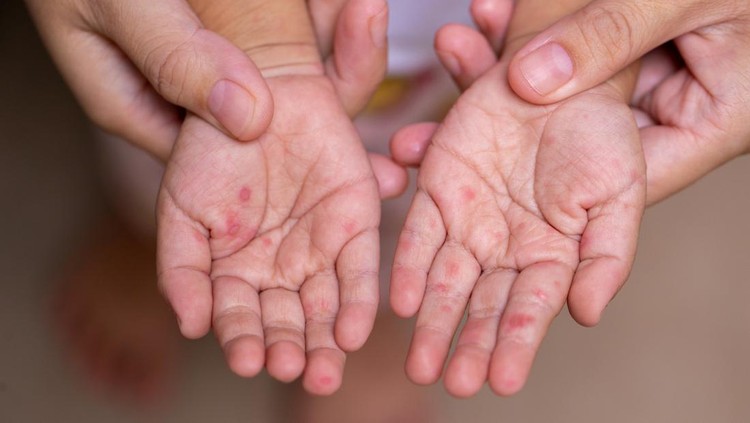 Ilustrasi Scabies pada Anak