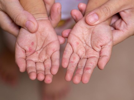 Cerita Bunda Hadapi Kedua Anaknya Alami Scabies, Bikin Tangan & Kaki Bernanah