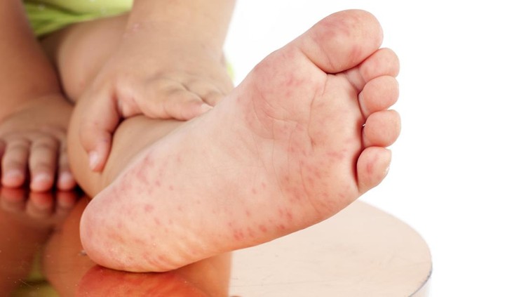 Ilustrasi Scabies pada Anak