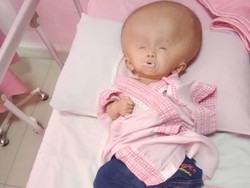 Yuk Kita Bantu Bagas, Penderita Hidosefalus Anak Kuli Panggul Kayu