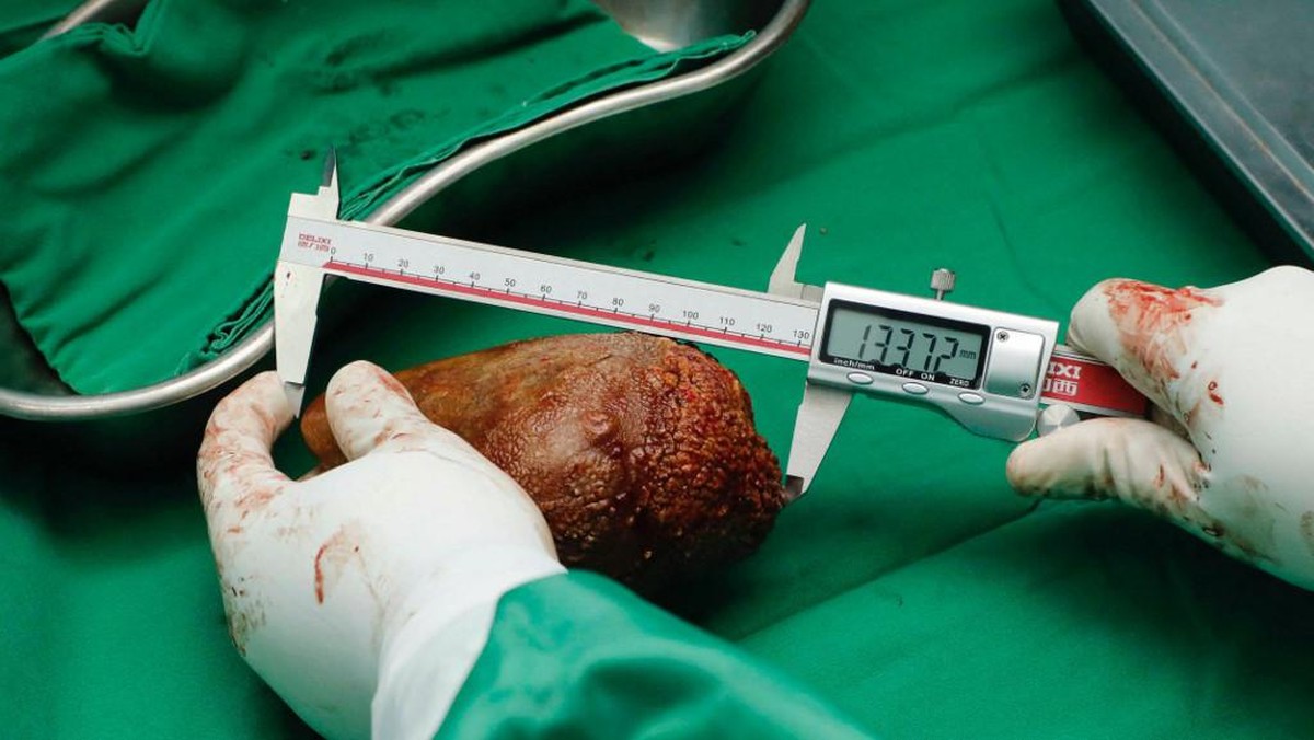 5 Makanan Ini Bisa Rusak Ginjal, Banyak Dikonsumsi Warga RI