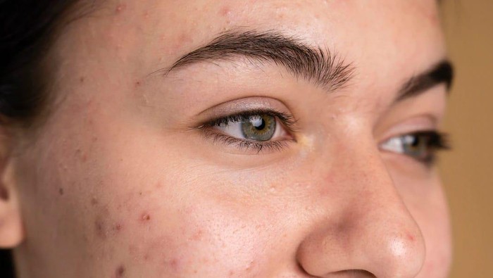 5 Jenis Jerawat yang Sering Muncul, Apa Saja?