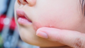 PITYRIASIS ALBA PADA ANAK