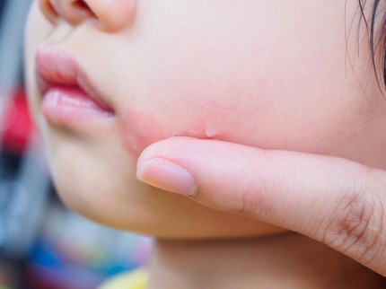 Ruam Putih pada Kulit Bayi, Bisakah Disembuhkan? Ini Kata Dokter Anak