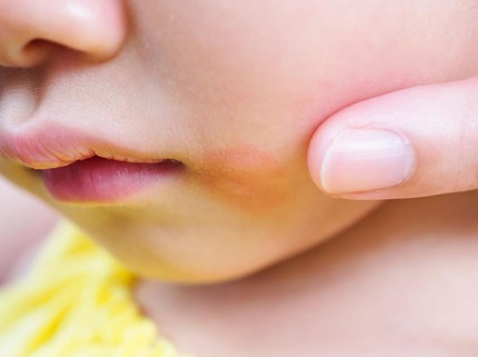 Kenali Pityriasis Alba, Kondisi Bercak Putih pada Pipi Anak yang Sering Dikira Kena ASI