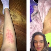 Sempat Mengira Cuma Ruam, Ternyata Turis Ini Kemasukan Cacing Akibat Rebahan di Pantai! Duh...