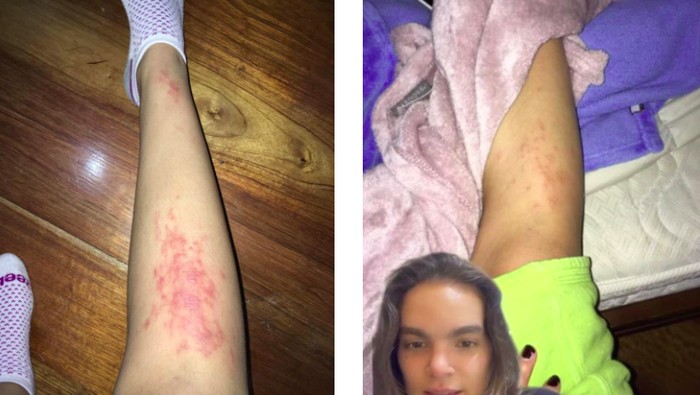 Sempat Mengira Cuma Ruam, Ternyata Turis Ini Kemasukan Cacing Akibat Rebahan di Pantai! Duh...