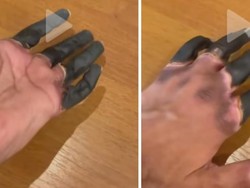 Viral Video Jari Menghitam Kena Frostbite Berujung Diamputasi