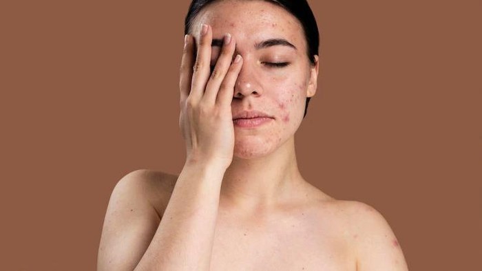5 Kandungan Skincare untuk Menenangkan Kulit Iritasi dan Kemerahan