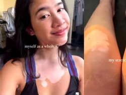 Kena Vitiligo, Dokter Salma Berjuang Lawan Insecure hingga Sukses Jadi Model