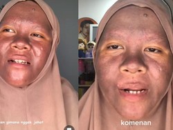 Awal Mula Wanita Kaltim Pakai Krim Pemutih Berujung Wajah Menggosong