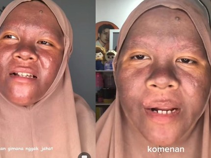 Cerita Wanita Kaltim Wajahnya Gosong Usai Pakai Krim Wajah, Awalnya Glowing Banget