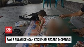 VIDEO: Bayi 8 Bulan dengan Kaki Enam Segera Dioperasi