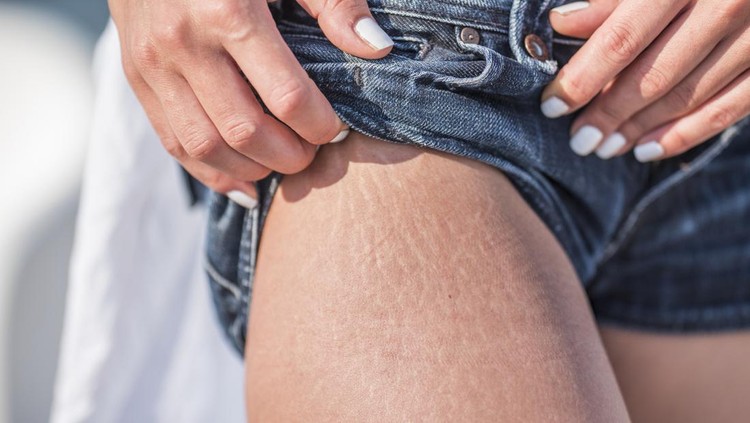 1024780080 Stretch marks on a caucasian woman's leg.