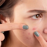 Jerawat Tak Kunjung Sembuh? Mungkin Kamu Terkena Skin Picking Disorder, Yuk Kenali di Sini!