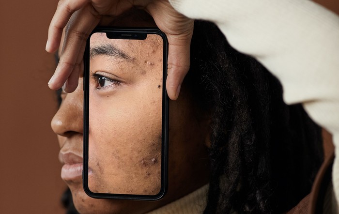 Tanda terkena skin picking disorder