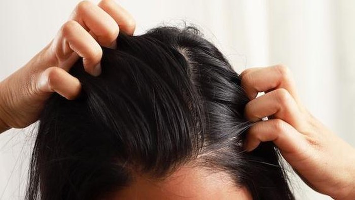 6 Cara Ampuh Hilangkan Kutu Rambut dan Telurnya