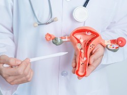 Benarkah Tumbuh Rambut Berlebihan pada Wanita Tanda PCOS? Dokter Bilang Gini