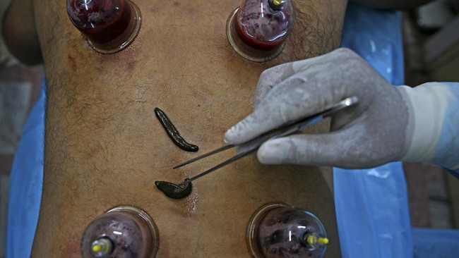 FOTO: WHO 'Kepincut' Konsep Pengobatan Tradisional