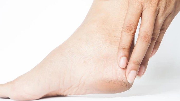 6 Cara Mengatasi Tumit Kaki Pecah-pecah dan Kering, Mudah Dilakukan di Rumah!