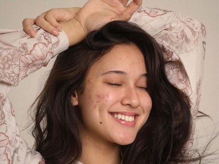 Yasmin Napper Unggah Foto Wajah Berjerawat, Tuai Pujian Disebut Tetap Cantik