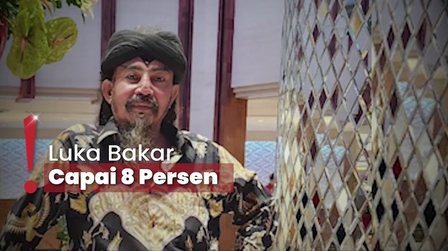 Kondisi Limbad Terungkap usai Gagal Atraksi Sembur Api-Jenggot Terbakar