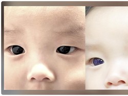 Viral Mata Bayi di Thailand Berubah Jadi Biru usai Perawatan COVID-19