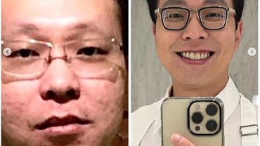 img-title Wajah Bopeng Terungkap, Richard Lee: Aku Sering Pencet Jerawat