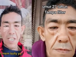 Curhat Pria Aceh Kena Sindrom Langka, Wajah Tua Dikira Pakai Filter