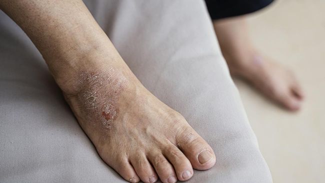 How to Treat Eczema on the Feet: Causes, Types, and Tips