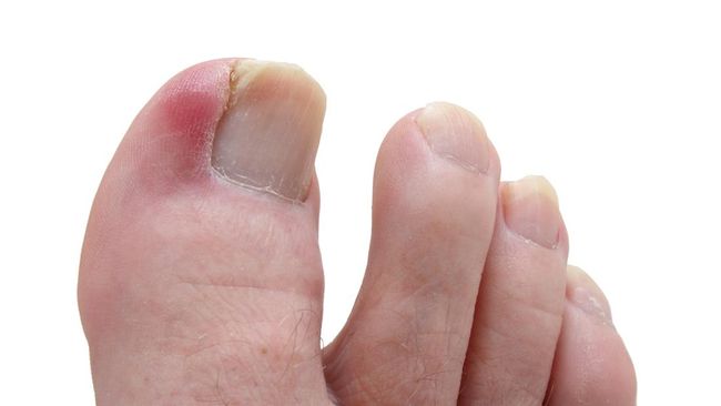 Cara mengobati cantengan di jempol kaki dapat dilakukan sendiri di rumah untuk bantu redakan bengkak dan nyeri sekaligus mencegah infeksi lebih serius.