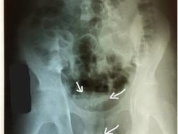Ngilu, Kabel 20 Cm Nyangkut di Mr P Remaja gegara Fetish Ekstrem
