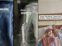 Kisah Viral Wanita Bandung Dikira Alami Pegal Biasa Ternyata Kanker Tulang