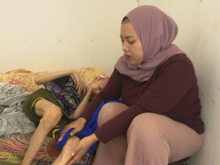 Kisah Pilu Omang Penderita Kelainan Kulit, Kurus Kering hingga Hilang Gigi dan Kuku