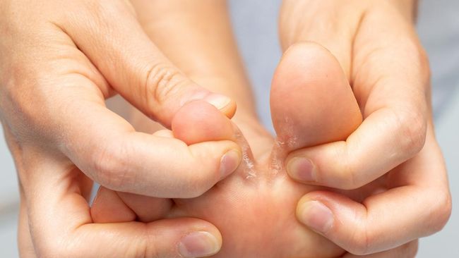 Cara mengobati kutu air di sela jari kaki dapat dilakukan dengan mudah menggunakan bahan-bahan sederhana yang ada di rumah.