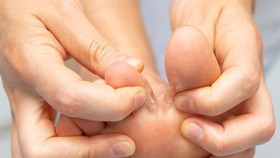 7 Cara Mengobati Kutu Air di Sela Jari Kaki dengan Bahan Sederhana