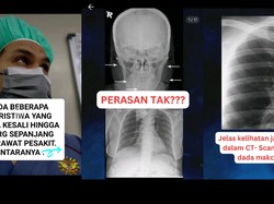 Tak Cuma di Negeri Jiran, Kasus Pasien dengan Susuk Juga Ada di Indonesia