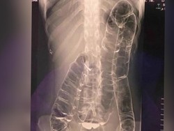 Viral Rontgen Usus Naik ke Dada, Cuma karena Sembelit? Dokter: Hernia Diafragmatika