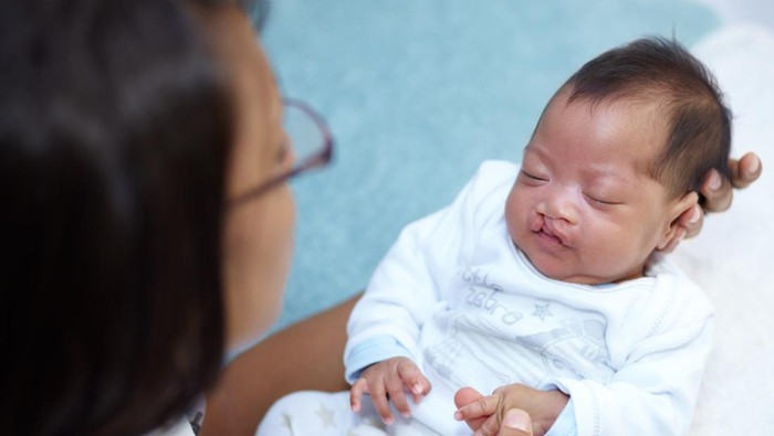 Ilustrasi Bayi dengan Bibir Sumbing