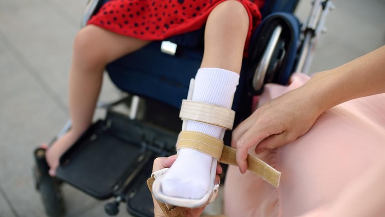 Ilustrasi Cerebral Palsy
