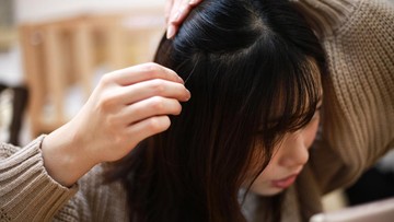 FAKTA TRANSPLANTASI RAMBUT