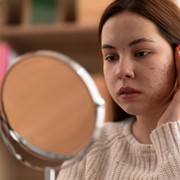 Mengenal Istilah Purging, Gejala Awal yang Sering Timbul Akibat Pemakaian Produk Skincare Baru