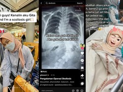 Viral Kisah Wanita Bandung Idap Skoliosis, Sudah Bengkok 40 Derajat di Usia 15