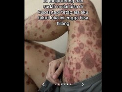 Mengenal Penyakit Kulit Stevens Johnson Syndrome