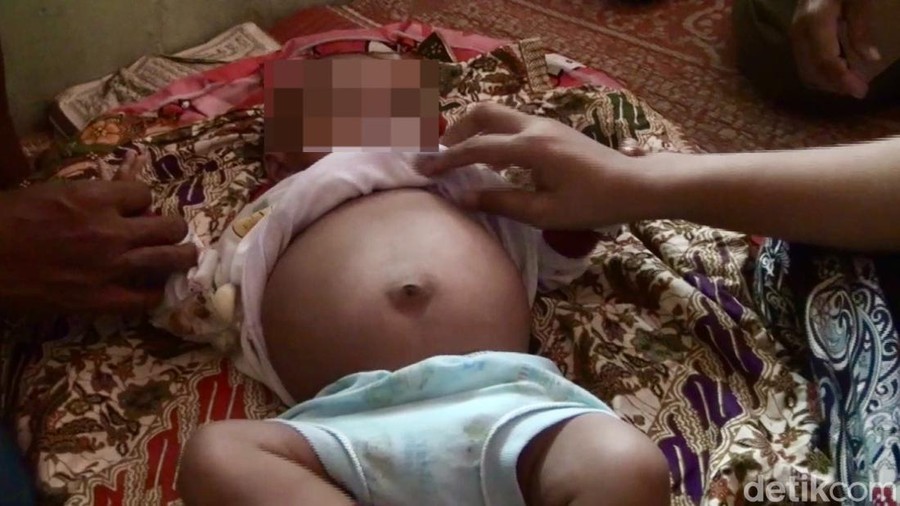Adnan, bayi yang disebut orang tuanya hamil 4 bulan. (Jeka Kampai/detikSumut) Adnan, bayi yang disebut orang tuanya hamil 4 bulan. (Jeka Kampai/detikSumut)