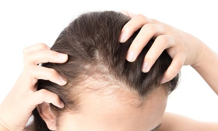 Dampak Buruk Mengikat Rambut Terlalu Erat dan Lama