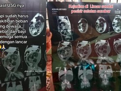 Viral Bayi 5 Bulan Hamil Diduga Fetus in Fetu, Kondisi Apa Itu?